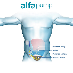 torso with implanted alfapump